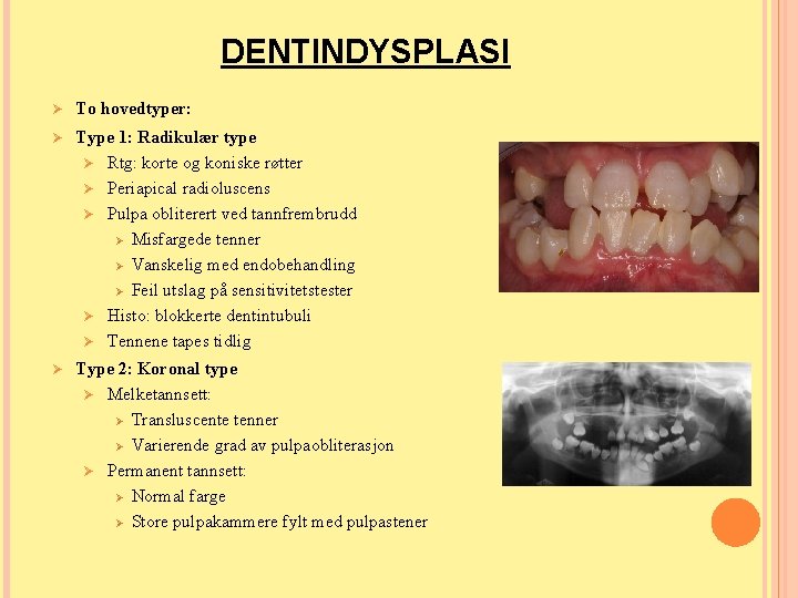 DENTINDYSPLASI Ø To hovedtyper: Ø Type 1: Radikulær type Ø Rtg: korte og koniske DENTINDYSPLASI Ø To hovedtyper: Ø Type 1: Radikulær type Ø Rtg: korte og koniske