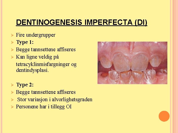 DENTINOGENESIS IMPERFECTA (DI) Ø Ø Ø Ø Fire undergrupper Type 1: Begge tannsettene affiseres DENTINOGENESIS IMPERFECTA (DI) Ø Ø Ø Ø Fire undergrupper Type 1: Begge tannsettene affiseres