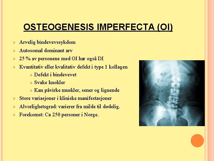 OSTEOGENESIS IMPERFECTA (OI) Ø Arvelig bindevevssykdom Ø Autosomal dominant arv Ø 25 % av OSTEOGENESIS IMPERFECTA (OI) Ø Arvelig bindevevssykdom Ø Autosomal dominant arv Ø 25 % av