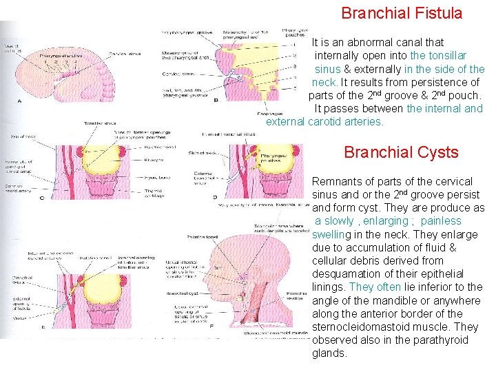 Branchial Fistula It is an abnormal canal that internally open into the tonsillar sinus