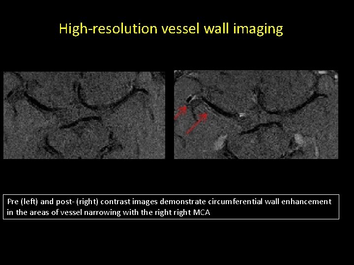 High-resolution vessel wall imaging Pre (left) and post- (right) contrast images demonstrate circumferential wall