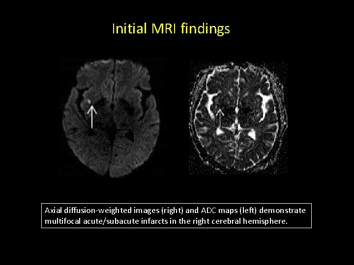 Initial MRI findings Axial diffusion-weighted images (right) and ADC maps (left) demonstrate multifocal acute/subacute