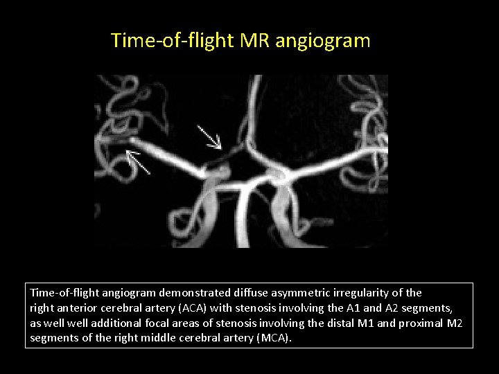 Time-of-flight MR angiogram Time-of-flight angiogram demonstrated diffuse asymmetric irregularity of the right anterior cerebral