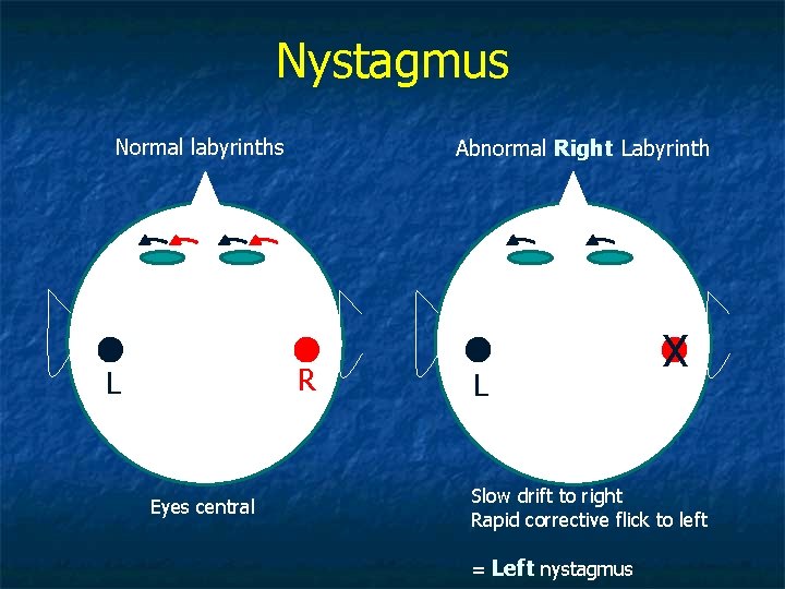 Nystagmus Normal labyrinths Abnormal Right Labyrinth R L Eyes central L X Slow drift