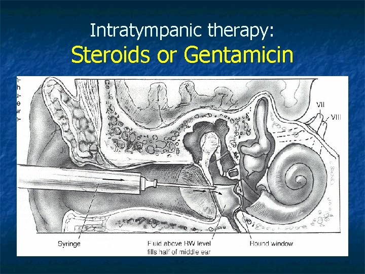 Intratympanic therapy: Steroids or Gentamicin 