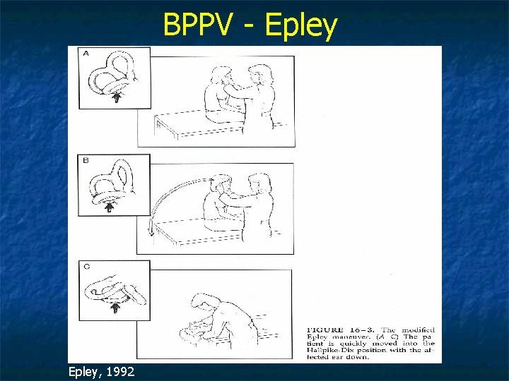 BPPV - Epley, 1992 