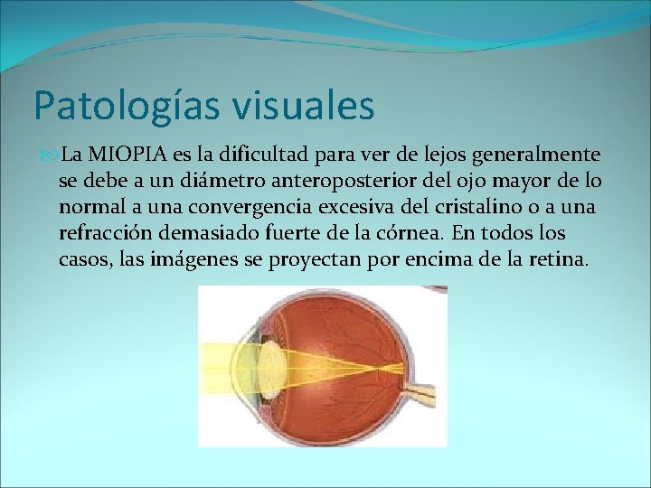 Patologías visuales La MIOPIA es la dificultad para ver de lejos generalmente se debe