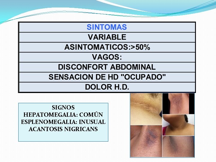 SIGNOS HEPATOMEGALIA: COMÚN ESPLENOMEGALIA: INUSUAL ACANTOSIS NIGRICANS 