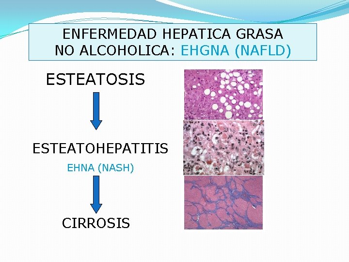 ENFERMEDAD HEPATICA GRASA NO ALCOHOLICA: EHGNA (NAFLD) ESTEATOSIS ESTEATOHEPATITIS EHNA (NASH) CIRROSIS 