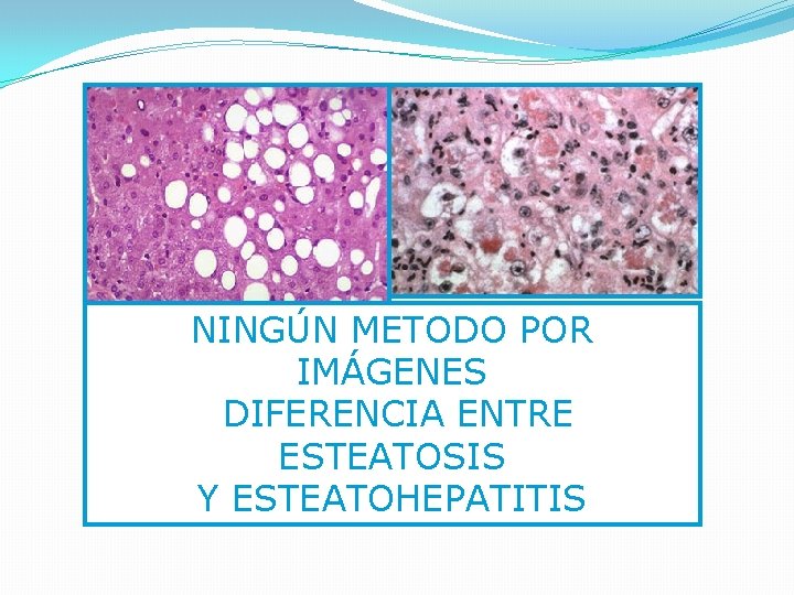 NINGÚN METODO POR IMÁGENES DIFERENCIA ENTRE ESTEATOSIS Y ESTEATOHEPATITIS 