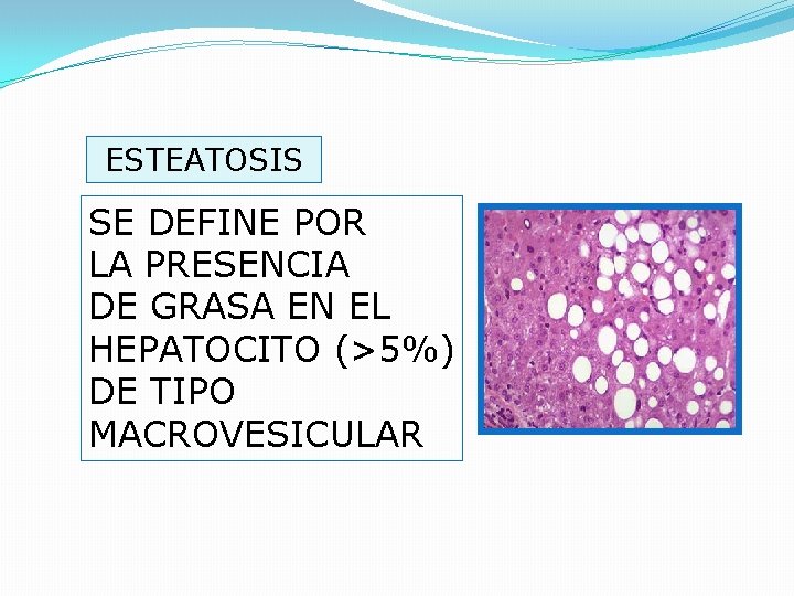 ESTEATOSIS SE DEFINE POR LA PRESENCIA DE GRASA EN EL HEPATOCITO (>5%) DE TIPO