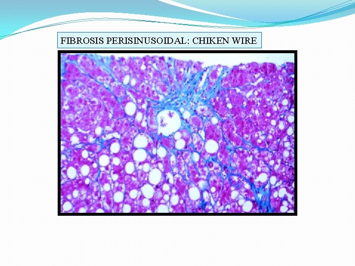 FIBROSIS PERISINUSOIDAL: CHIKEN WIRE 