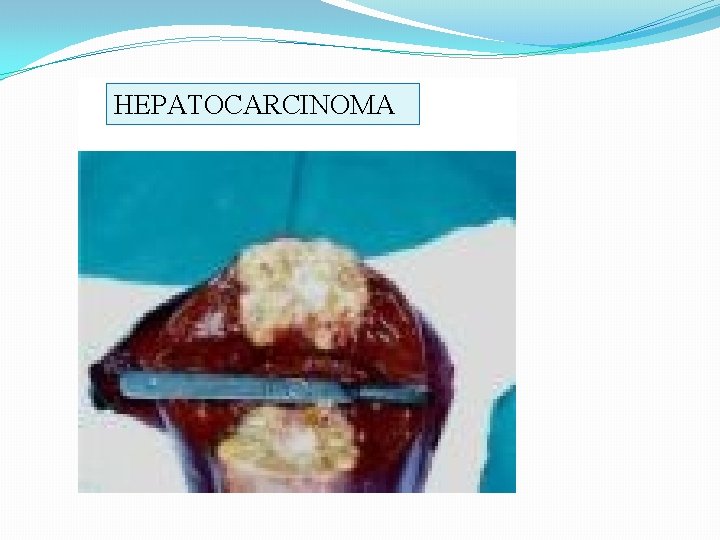 HEPATOCARCINOMA 