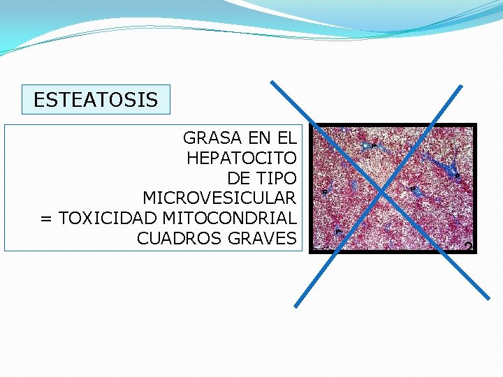 ESTEATOSIS GRASA EN EL HEPATOCITO DE TIPO MICROVESICULAR = TOXICIDAD MITOCONDRIAL CUADROS GRAVES 
