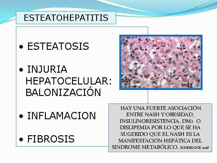 ESTEATOHEPATITIS • ESTEATOSIS • INJURIA HEPATOCELULAR: BALONIZACIÓN • INFLAMACION • FIBROSIS HAY UNA FUERTE