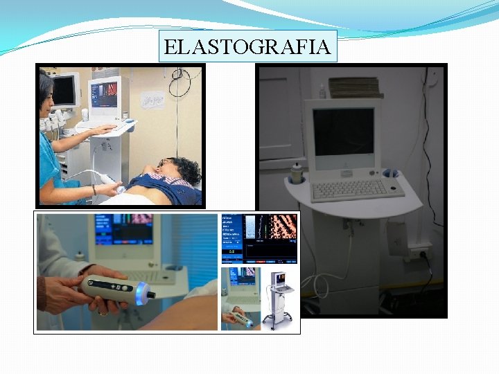 ELASTOGRAFIA 