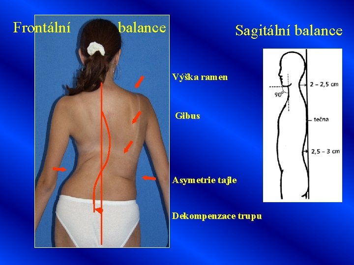 Frontální balance Sagitální balance Výška ramen Gibus Asymetrie tajle Dekompenzace trupu 