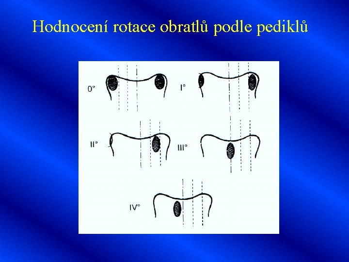 Hodnocení rotace obratlů podle pediklů 