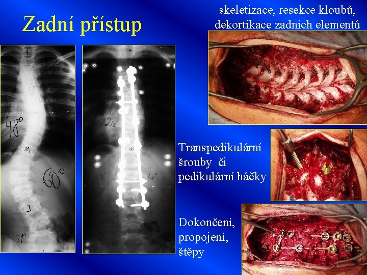 Zadní přístup skeletizace, resekce kloubů, dekortikace zadních elementů Transpedikulární šrouby či pedikulární háčky Dokončení,