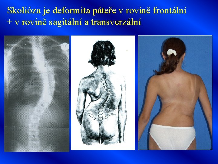 Skolióza je deformita páteře v rovině frontální + v rovině sagitální a transverzální 