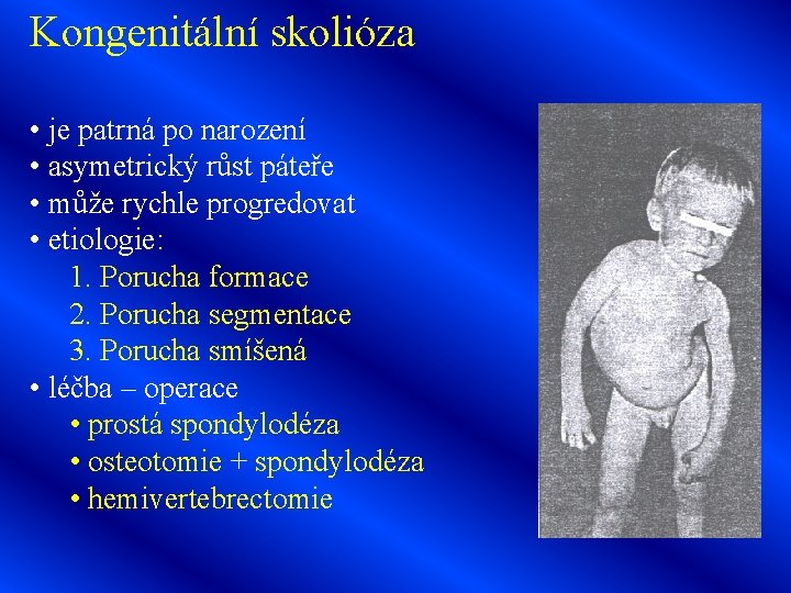 Kongenitální skolióza • je patrná po narození • asymetrický růst páteře • může rychle