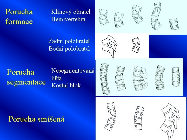 Porucha formace Klínový obratel Hemivertebra Zadní polobratel Boční polobratel Porucha segmentace Nesegmentovaná lišta Kostní