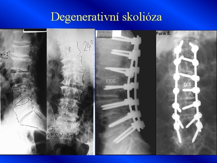 Degenerativní skolióza 