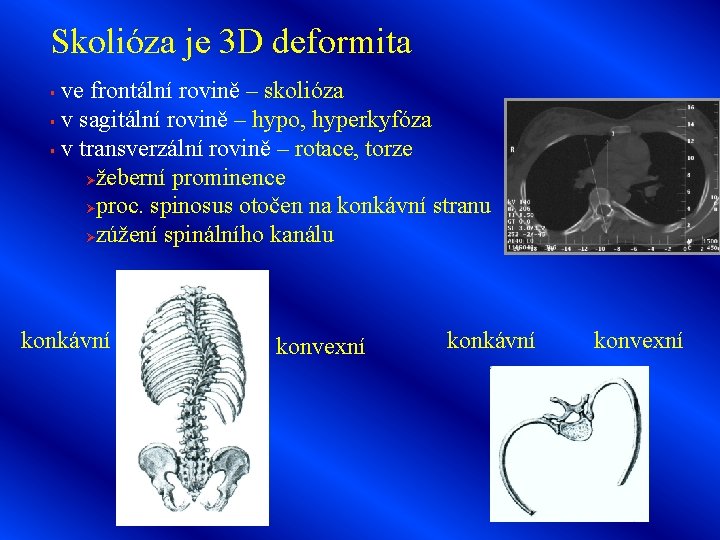 Skolióza je 3 D deformita ve frontální rovině – skolióza § v sagitální rovině
