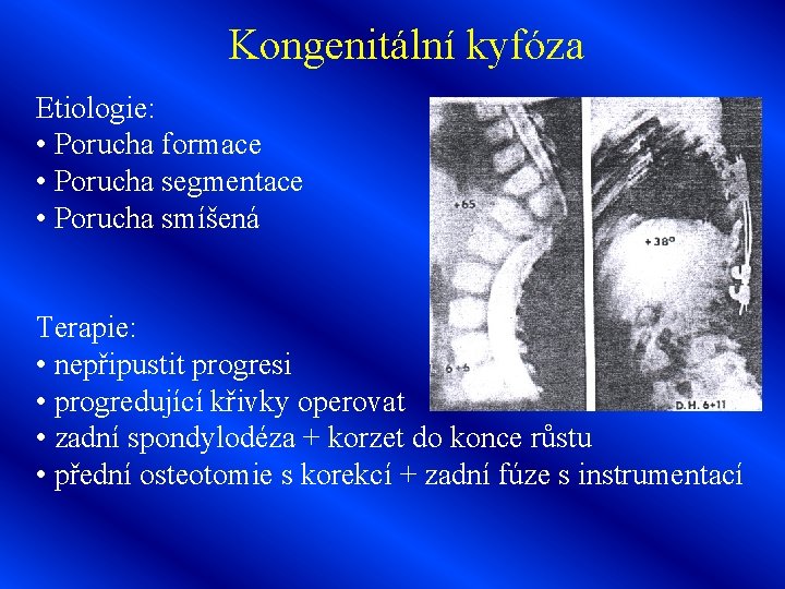 Kongenitální kyfóza Etiologie: • Porucha formace • Porucha segmentace • Porucha smíšená Terapie: •