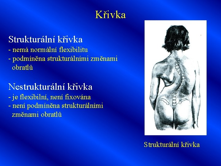 Křivka Strukturální křivka - nemá normální flexibilitu - podmíněna strukturálními změnami obratlů Nestrukturální křivka