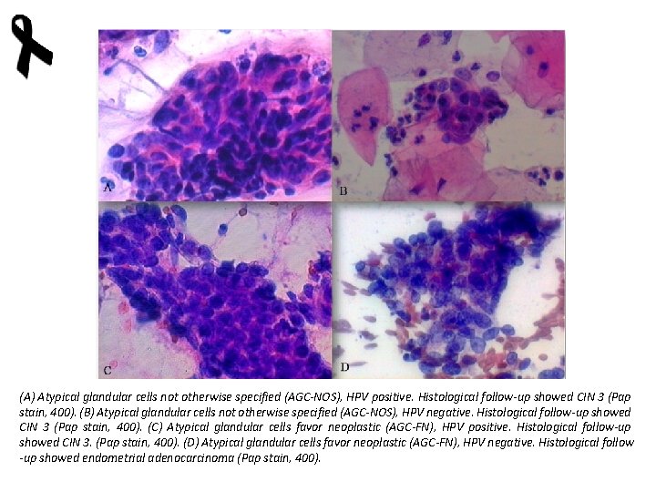 (A) Atypical glandular cells not otherwise specified (AGC-NOS), HPV positive. Histological follow-up showed CIN