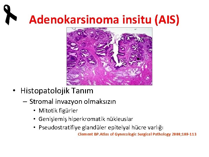 Adenokarsinoma insitu (AIS) • Histopatolojik Tanım – Stromal invazyon olmaksızın • Mitotik figürler •