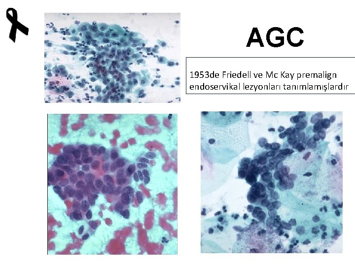 AGC 1953 de Friedell ve Mc Kay premalign endoservikal lezyonları tanımlamışlardır 