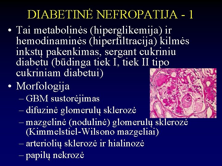 DIABETINĖ NEFROPATIJA - 1 • Tai metabolinės (hiperglikemija) ir hemodinaminės (hiperfiltracija) kilmės inkstų pakenkimas,