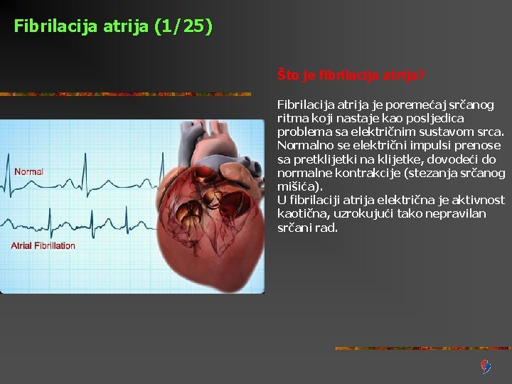 Fibrilacija atrija (1/25) Što je fibrilacija atrija? Fibrilacija atrija je poremećaj srčanog ritma koji