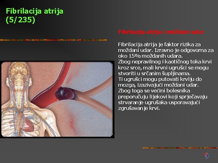 Fibrilacija atrija (5/235) Fibrilacija atrija i moždani udar Fibrilacija atrija je faktor rizika za