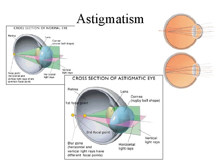 Astigmatism 