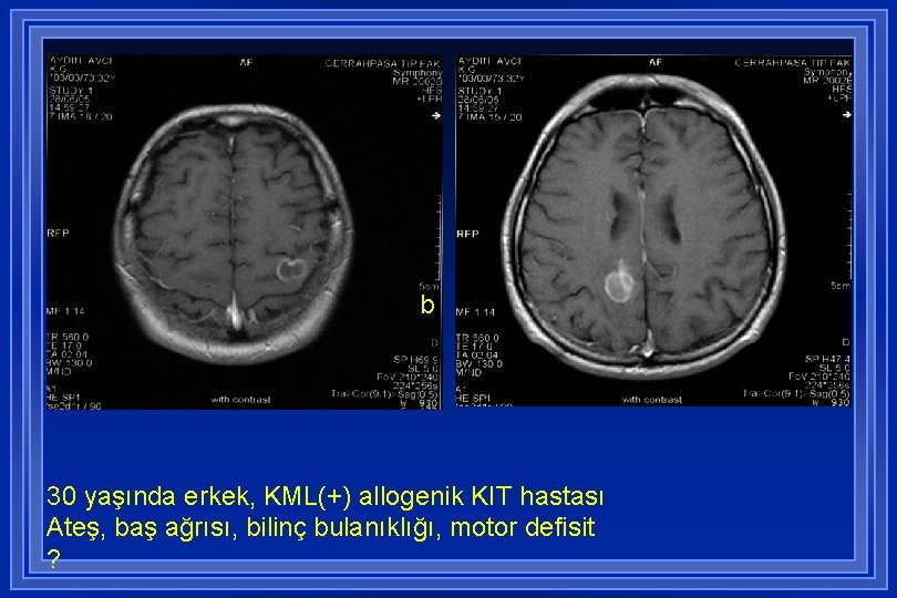 b 30 yaşında erkek, KML(+) allogenik KIT hastası Ateş, baş ağrısı, bilinç bulanıklığı, motor
