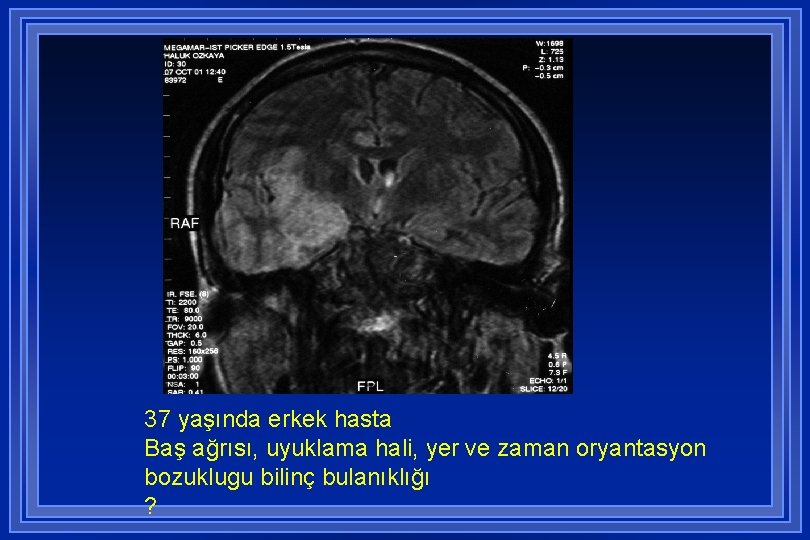 37 yaşında erkek hasta Baş ağrısı, uyuklama hali, yer ve zaman oryantasyon bozuklugu bilinç