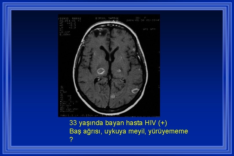 33 yaşında bayan hasta HIV (+) Baş ağrısı, uykuya meyil, yürüyememe ? 