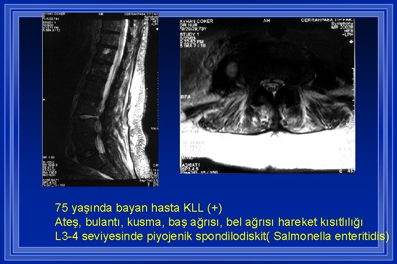 ) 75 yaşında bayan hasta KLL (+) Ateş, bulantı, kusma, baş ağrısı, bel ağrısı