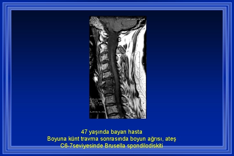 47 yaşında bayan hasta Boyuna künt travma sonrasında boyun ağrısı, ateş C 6 -7