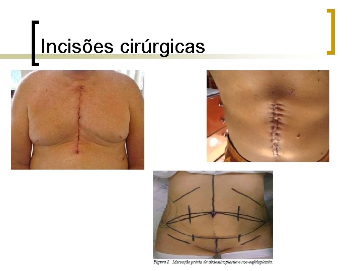 Incisões cirúrgicas Incisões cirúrgicas