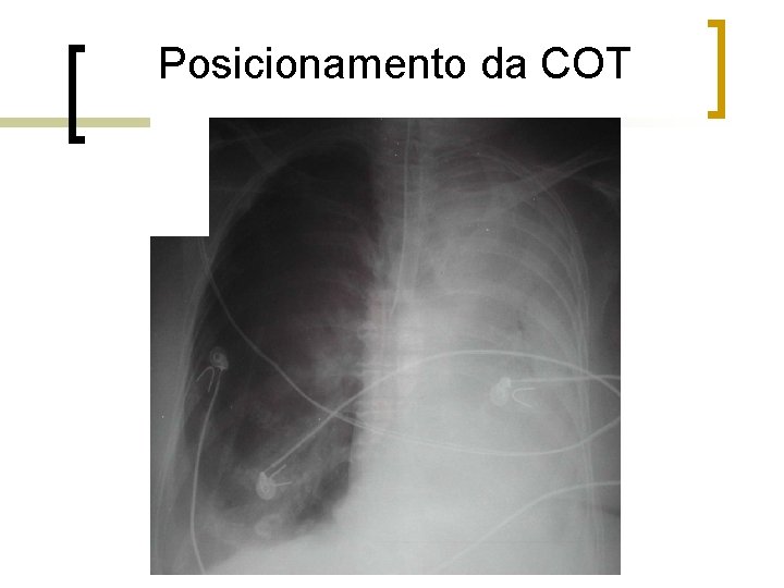 Posicionamento da COT Posicionamento da COT