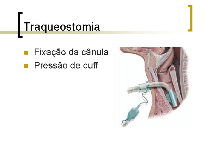 Traqueostomia n n Fixação da cânula Pressão de cuff Traqueostomia n n Fixação da cânula Pressão de cuff