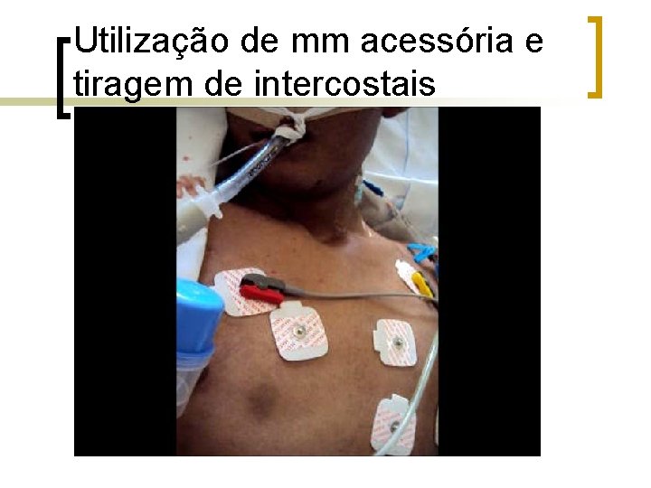 Utilização de mm acessória e tiragem de intercostais Utilização de mm acessória e tiragem de intercostais