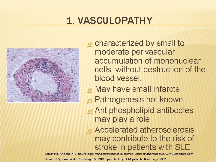 1. VASCULOPATHY characterized by small to moderate perivascular accumulation of mononuclear cells, without destruction