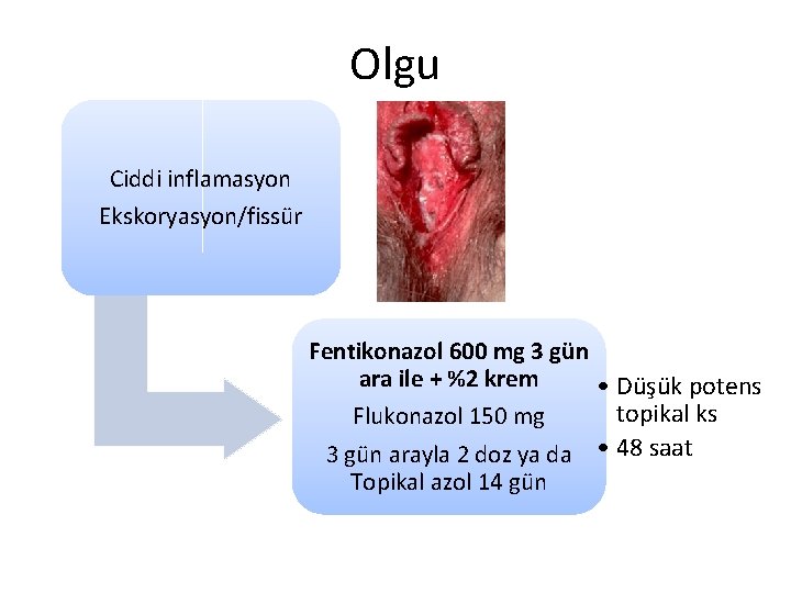 Olgu Ciddi inflamasyon Ekskoryasyon/fissür Fentikonazol 600 mg 3 gün ara ile + %2 krem