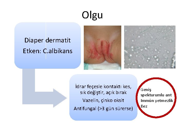 Olgu Diaper dermatit Etken: C. albikans İdrar feçesle kontaktı kes, sık değiştir, açık bırak
