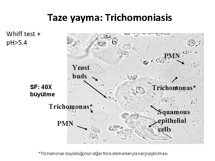 Taze yayma: Trichomoniasis Whiff test + p. H>5. 4 PMN Yeast buds SF: 40